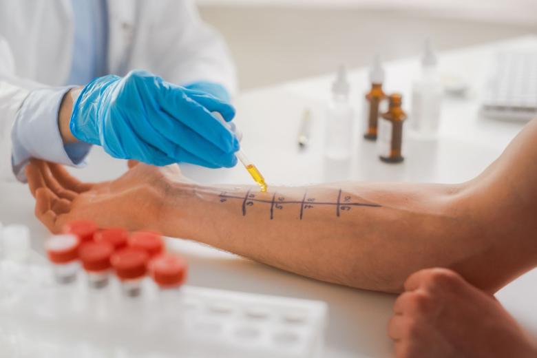 Lekarz nakłada pipetą preparaty z alergenami na ramie pacjenta, na którym oznaczonych jest 10 kratek z numerami