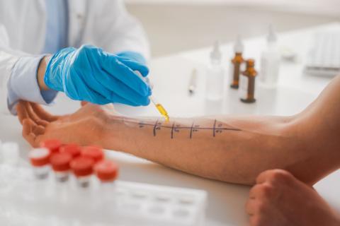 Lekarz nakłada pipetą preparaty z alergenami na ramie pacjenta, na którym oznaczonych jest 10 kratek z numerami